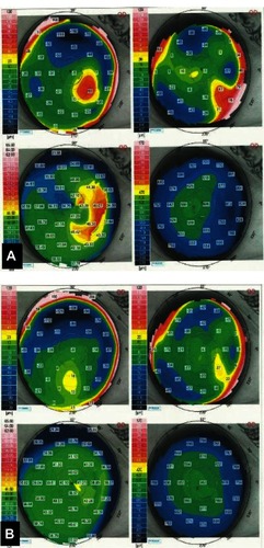 Figure 3 Corneal topography of case 1 (A) before and (B) six months after surgery.