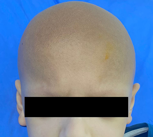 Figure 1 Numerous non-inflammatory follicular keratotic tiny papules on the patient’s scalp, eyebrows, and eyelashes.