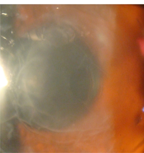 Figure 5 Paracentral perforation with double anterior chamber.