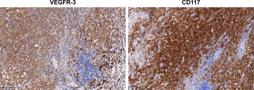 Figure 2 Immunohistochemical staining showing high expression of CD117 and VEGFR-3. Magnification power: 100×.