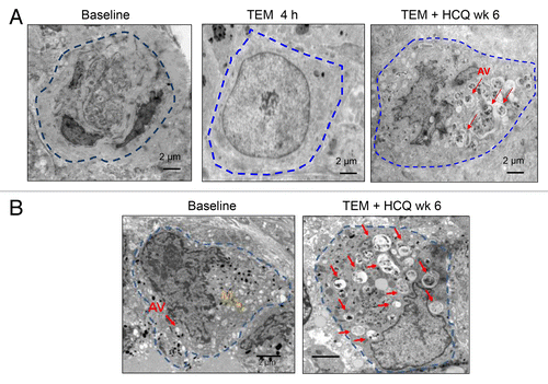 Figure 3. Therapy-associated autophagic vacuole accumulation in serial tumor biopsies from melanoma patients. Representative electron micrographs of a melanoma cell from 2 different patients (A and B) at the indicated timepoints. Dotted blue line: border of cytoplasmic membrane of 1 tumor cell. Red arrows, autophagic vacuoles. Yellow arrow, mitochondria.