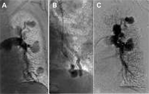 Figure 1 Pulmonary arteriovenous-fistula treatment.