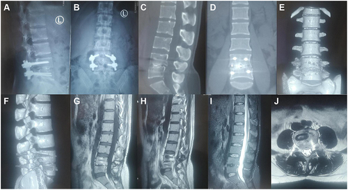 Figure 5 Radiological studies 2 years after discharge. Plain radiographs showed no abnormal changes in the fixed position of L4–L5 vertebral segments (A and B). No abnormalities on CT and MRI (C–J).
