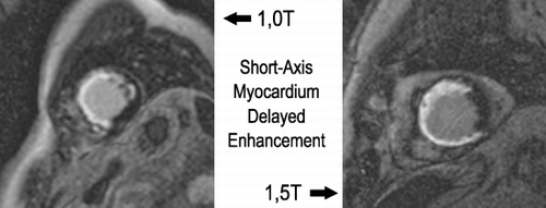 Figure 1. Short axis MDE comparison for 1.0 and 1.5T scanners.