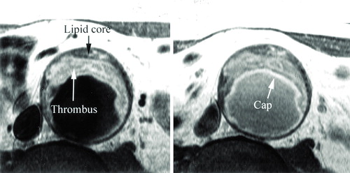 Figure 3. A T1‐weighted image from a patient with abdominal aortic aneurysm demonstrating bright signal within thrombus and darker signal in lipid core towards vessel wall (on the left). The cap region is faintly seen on the T1‐weighted image. A comparable T1‐weighted image, but several minutes after infusion of Gd‐DTPA, is shown on the right. Note the improved delineation of fibrous cap by bright signal within (arrow). (With permission from Kramer et al. 2004 Citation39.)