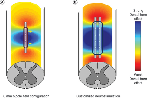 Figure 2. Illustrative depiction of neurostimulation field shapes. (A) Produced by an 8 mm bipole configuration typical of conventional spinal cord stimulation and (B) algorithmic-based customized spinal cord stimulation configuration designed to more optimally provide for stimulation of the spinal dorsal horn.