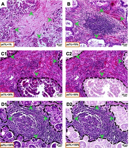 Figure 3 Representative views of TILs in GC cases.Notes: (A) psTIL=1% (×200), poorly differentiated adenocarcinoma; (B) psTIL=70% (×200), mucinous adenocarcinoma; (C) psTIL=30% (×200), moderately differentiated adenocarcinoma; (D) psTIL=100% (×200), highly differentiated adenocarcinoma; stromal TILs were defined and assessed according to steps shown from c1 to c2, and from d1 to d2. Tumor cells presented at all borders were indicated by green arrowheads.Abbreviations: TILs, tumor-infiltrating lymphocytes; GC, gastric cancer; psTIL, the percentage of stromal tumor-infiltrating lymphocytes.