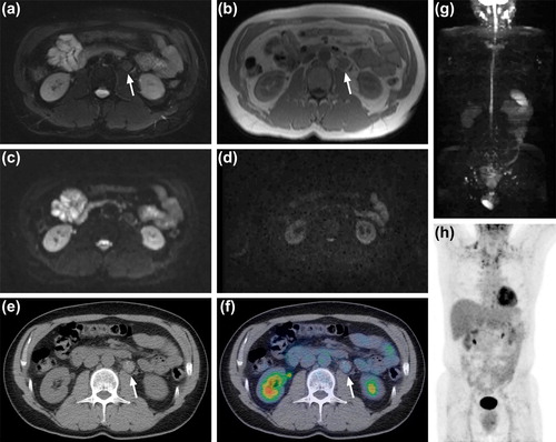 Figure 2. Follow-up WB MRI in a 60-year-old man with clinical stage II testicular cancer. A residual lymph node (arrow) was detected on T2-BLADE (a) and T1-Dixon (b) sequences. The DWI signal was not restricted; b50 (c), b1000 (d) and MIP-image (g). Low dose CT image (e), fused PET/CT image (f) and MIP PET/CT image (h) showed that the lymph node (arrows) was negative on 18F-FDG PET/CT performed six months before the WB MRI.