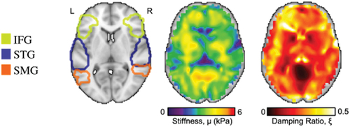 Figure 1. Regions included in the current analysis: inferior frontal gyrus (IFG), superior temporal gyrus (STG), and superior marginal gyrus (SMG). a) ROIs mapped on a single subject’s T1 scan alongside their corresponding whole brain b) stiffness map and c) damping ratio map. Stiffness and damping ratio were extracted for each unilateral ROI.