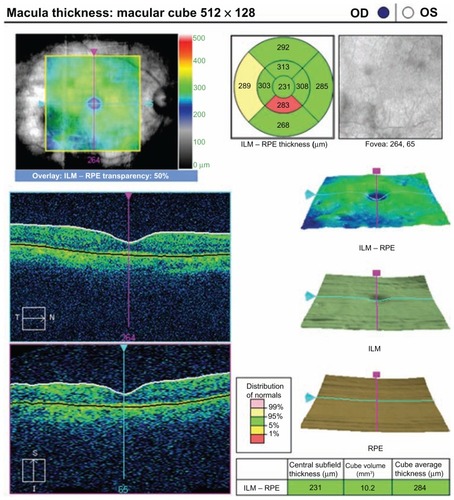 Figure 2 Optical coherence tomograph of the same patient in group 1 at the 3-month preoperative visit.