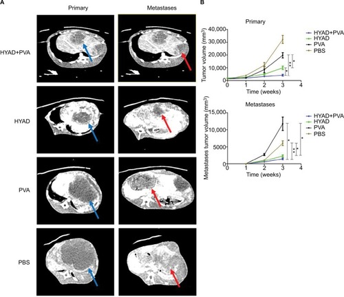 Figure 8 Tumor volumes of primary and metastatic lesions detected by contrast-enhanced CT scan.Notes: (A) Tumors of primary and metastases were illustrated at 3 weeks post the first interventional manipulation (primary tumor marked with blue arrow, metastases marked with red arrow). (B) Before interventional operation and at 1, 2, and 3 weeks post the first interventional manipulation, the volumes of primary and metastatic lesions were detected by contrast-enhanced CT scan. Each data point indicates mean ± SD.Abbreviations: HYAD, hypoxia-replicative oncolytic adenovirus; HYAD+PVA, HYAD combined with PVA particle embolization; PVA, polyvinyl alcohol.