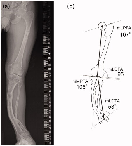 Figure 1. (a) Preoperative antero-posterior long-leg standing radiograph. (b) The schematic illustration of the joint orientation angles. The vertical black solid line represents mechanical axis. The bent dotted line indicates the apparent location of the tibial anatomical axis.