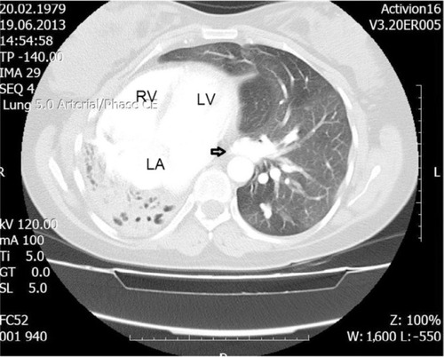 Figure 3 A lung window setting computed tomography scan.