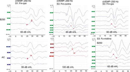 Figure 5 Typical VEMP responses where the separate curves are labeled by the dB nHL.