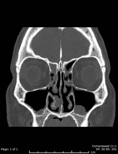 Figure 4 Paranasal CT scan showed bilateral accessory ostia and bilateral maxillary and ethmoidal sinusitis.