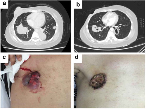 Figure 3. PR response to apatinib monotherapy treatment. (a) Chest CT scans before apatinib treatment (July 2016). (b) Chest CT scans after apatinib treatment (October 2016), the lesions especially in the right chest wall and the left lung metastasis demonstrated clear cavitation. (c) The expression of chest wall focus before apatinib treatment (July 2016). (d) The expression of chest wall focus after apatinib treatment (October 2016).