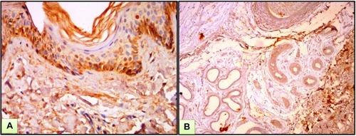 Figure 3 Normal skin. (A) Epidermis showed mild to moderate cytoplasmic expression of ATG7. (B) Dermis showed mild nucleocytoplasmic expression of ATG7 in hair follicle and eccrine sweat glands (ATG7 IHC ×200 for A and B).