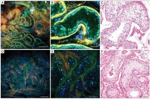 Figure 2. Seminiferous tubular histology patterns imaged by MPM at low (a and d) and high (b and e) magnification compared to high magnification stained tissue (c and f). Normal spermatogenesis is shown by green areas in A to C and seminiferous tubules with SCO pathology is shown by blue areas in D to F. H&E (c and f). Scale bar represents 500 μm (a and d) and 80 μm (b,c,e,f). Permission for reproduction obtained from Elsevier Publishing, Ramasamy et al. [Citation10]