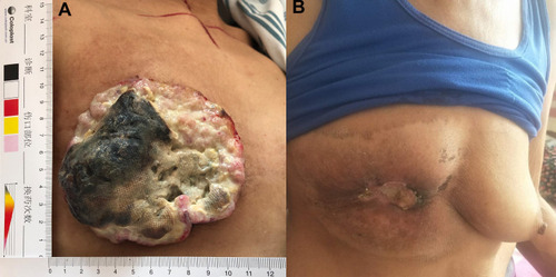 Figure 2 The effect evaluation between pre-RT and 2 months after RT. (A) The fungated, cauliflower-like tumor occupied the entire right breast before RT. (B) The tumor shrank significantly and eventually fell off 2 months after RT.