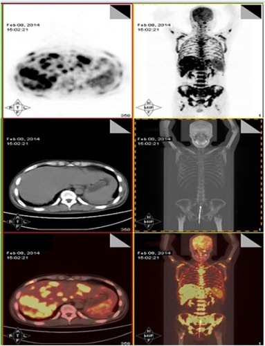 Figure 3 PET/CT (February 8, 2014) showing significantly progressive disease after changed regimen and discontinuation of treatment because of liver dysfunction.