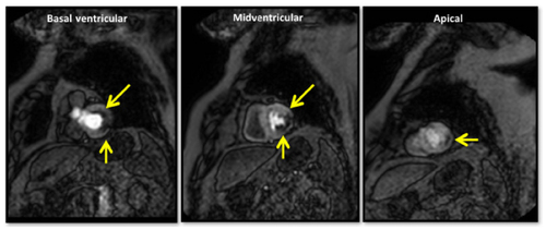 Figure 5 A 77-year-old man with previous coronary artery bypass grafting and worsening dyspnea with exertion presented for stress CMR.