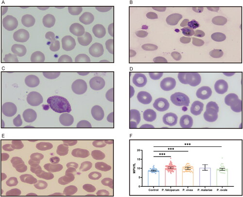 Figure 3. Platelets enlarge in apparent size in the formation of platelet–iRBC aggregates. (A) Platelets adhere to uninfected erythrocytes in healthy controls. (B) Platelets bind to P. falciparum-infected erythrocytes at the ring stage. (C) Platelets attach to erythrocytes infected with P. vivax at the gametocyte stage. (D) Platelets cling to erythrocytes infected with P. ovale at the trophozoite stage. (E) Platelets bond to P. malariae-infected erythrocytes at the trophozoite stage. (F) Platelets volume comparison.