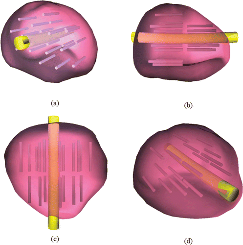 Figure 4. Reconstructed prostate (model B), combined with an assumed urethral warmer and a cryoprobe layout based on bubble-packing results for 14 cryoprobes in Stage I and 7 cryoprobes in Stage II. [Color version available online.]
