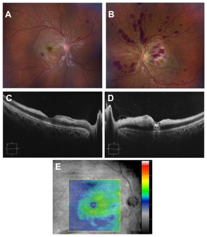 Figure 1 (A and B) Color fundus photograph montages showing disk edema, diffuse retinal whitening, and retinal hemorrhages more prominent in the left eye compared to the right eye. (C) Optical coherence tomography showing atrophy of the temporal retina and disruption of inner segment–outer segment junction of the photoreceptor in the right eye. (D) Optical coherence tomography revealing edema of the nasal macula and central foveal hyper-reflectivity consistent with a scar in the left eye. (E) Optical coherence tomography thickness map of the right eye demonstrating temporal thinning.