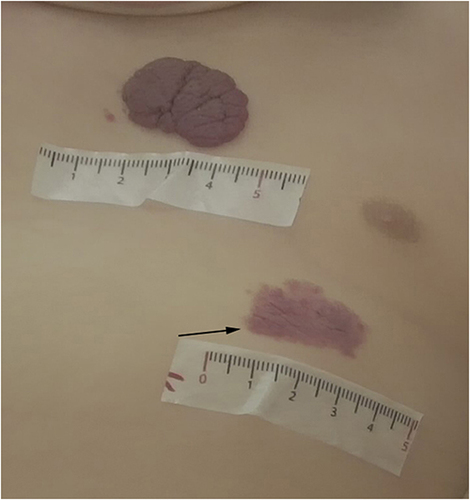 Figure 5 After 3 months of treatment, the two-hemangioma lesion became flat. The black arrow indicates the observation area for the dermoscope.