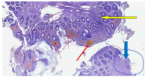 Figure 2 Low power photomicrograph revealing fragments of mucosal biopsy with foci of lymphoplasmacytic (yellow arrow) lamina propria infiltration, hemorrhage (red arrows) and a focus of an egg of S. mansoni (down blue arrow).