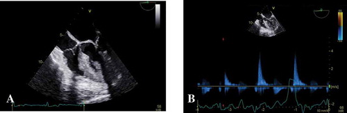 Figure 2. Echocardiogram of 46-year-old woman with apical hypertrophic cardiomyopathy (a and b), which revealed severe symmetric left ventricular hypertrophy with apical hypertrophy with near obliteration of the left ventricular cavity during systole.