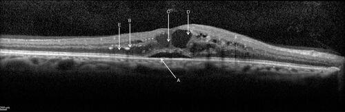 Figure 2 OCT biomarkers in DME: A. Subretinal fluid (SRF), B. Hyperreflective retinal spots (HRS), C. Intraretinal cysts (IRC), D. Disorganization of retinal inner layers (DRIL), E. Hard exudates. Courtesy Ana Rita Santos.