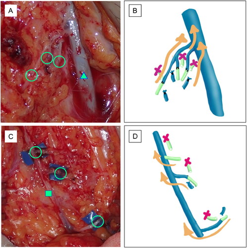 Figure 2. Intraoperative findings. Three lymphatic vessels and three veins are anastomosed in each of the right (A) and left (C) groin regions. The circles indicate the anastomoses. The triangle indicates the great saphenous vein (A). The tetragon indicates the accessory saphenous vein (C). The schema indicates the LVA on the right (B) and left (D) sides.