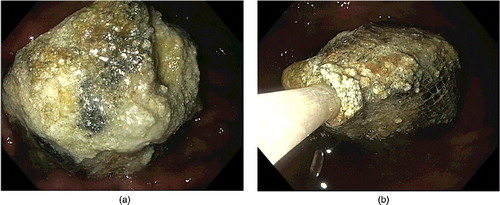 Figure 2. (a) Carbamazepine bezoar seen on esophagogastroduodenoscopy in situ measuring 5 cm in diameter, 9.9 g by weight on laboratory analysis. (b) The pharmacobezoar was fragmented and captured using a Roth Net. Three passes of the endoscope were required and an esophageal overtube was used to facilitate the complete retrieval of pharmacobezoar.