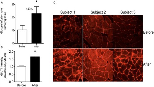 Figure 3. Insulin sensitivity and skeletal muscle glucose transporter type 4 (GLUT4) localization before and after cold acclimation: (A) group mean ± SEM for glucose infusion rate during a hyperinsulinaemic euglycaemic clamp, which is the measurement for insulin sensitivity; (B) GLUT4 translocation in skeletal muscle before and after acclimation in type 2 diabetes patients, as made visible in: (C) representative images of GLUT4 immunostaining of skeletal muscle tissue sections from three individuals in the study. GLUT4 is the insulin-regulated glucose transporter in skeletal muscle fibres. The pictures show that there is more GLUT 4 on the membranes of the cells after cold acclimation. Source: Figure from Hanssen et al. (Citation2015).