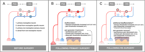 Figure 4 Pathophysiological Mechanisms. A schematic presentation of putative pathophysiological mechanisms in persistent severe pain after groin hernia repair. (A) Depicts the normal conditions of the nociceptive (red) and non-nociceptive system (blue) circuitry from the primary afferents to the dorsal horn neurons with ensuing central projections. The “mirrored” arrows indicate the crosstalk between the circuitries in the peripheral and central nervous systems. Following the primary surgery (B), an inflammatory reaction surrounding the polypropylene mesh implant, may develop into a peripheral “pain generator”, ie, a “meshoma”. The “pain-generator”, including neo-innervation and reinnervation of nerve fibers, induces increased nociceptive-signaling from the fascial layers, eg, a lowered blunt pressure pain threshold (PPT). In contrast, the surgery causes a long-term “deafferentation”: a reduction in intraepidermal nerve fiber density (IENFD), leading to increased cutaneous thermal and mechanical detection and pain thresholds. Following re-surgery (C), the mesh explant leads to removal of the functional “pain generator”: the spontaneous and evoked pain diminishes (increase in PPT). However, the re-surgery also increases the cutaneous deafferentation (reduction of IENFD) leading to an additional increase of cutaneous thermal and mechanical thresholds.