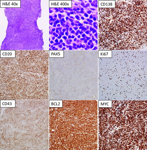 Figure 2. Morphologic and immunohistochemical characterization of the neoplastic cells. Unless otherwise indicated, the images are taken using 100x magnification.