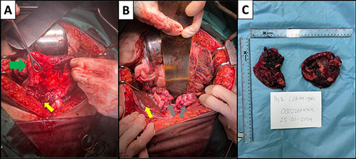 Figure 2 Surgery finding; (A) intra-operative image of ruptured cyst endometriomas, green arrow showed the wall of ruptured cyst, yellow arrow showed fluid-like fluid in intraabdominal; (B) intra-operative image of chocolate cyst after evacuated, grey arrow showed the cyst that had been sutured, yellow arrow showed chocolate-like fluid in intraabdominal; (C) gross specimen of rupture endometriomas.