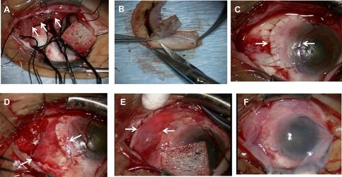 Figure 2 Surgical procedure (photographs). (A) Application of pieces of sponge (arrows) soaked in 0.04% mitomycin C. (B) The cryopreserved limbal allograft was trimmed. (C) The cryopreserved limbal allograft (between arrows) was placed on the bare limbus and sclera with 10–0 nylon sutures. (D) Amniotic membrane (between arrows) transplantation on the bare sclera and the sclera of the cryopreserved limbal allograft. (E) A conjunctival epithelium flap (between arrows) from the superior area was rotated, positioned, and secured on the amniotic membrane with 9–0 Vicryl sutures. (F) Amniotic membrane was placed on the ocular surface.