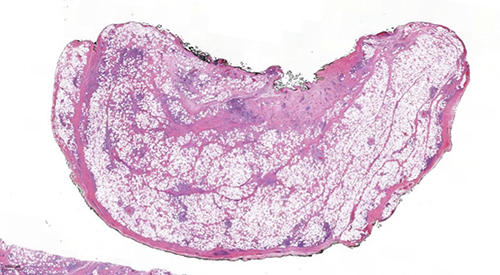 Figure 6 Hematoxylin and eosin (H&E) (1×) Whole mount section of the orbital mass demonstrates an encapsulated adipose tissue mass, with foci of lymphoid aggregates.