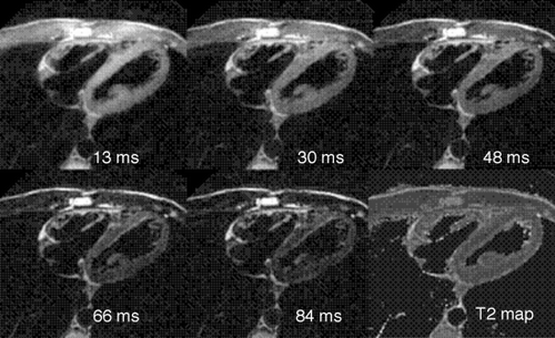 Figure 1. Images at various TEaff and T2 map generated from a single DBIR RADFSE k‐space data set.