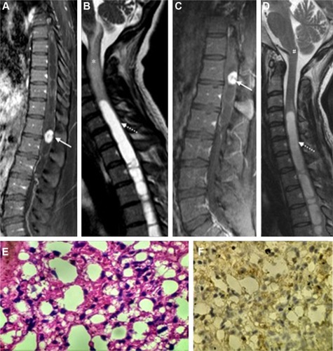 Figure 1 Imaging and histological findings of spinal hemangioblastoma during puerperium.