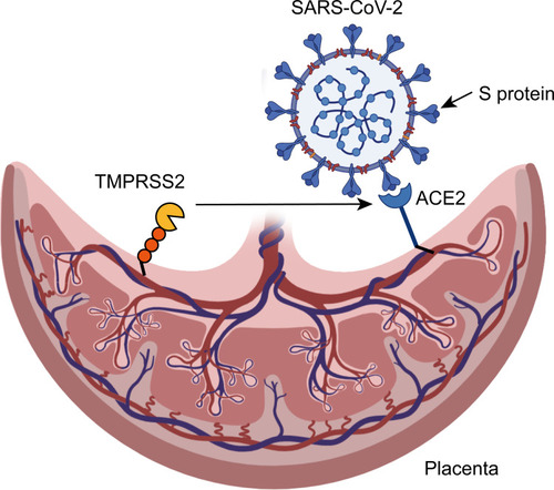 Figure 2 The possible mechanism of vertical transmission of SARS-CoV-2 in pregnant women.