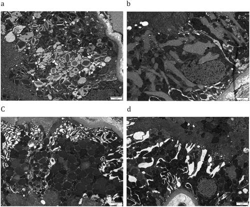 Figure 2. Pathologic features of LCPT by transmission electron microscopy (TEM). A) TEM showed the proximal tubular cells were occupied by crystals of varying size and shapes (×8000). B) the proximal tubular epithelial cells were variably distended by fibrillary cytoplasmic inclusions (×8000), with compression of the nuclear contours. C) The endosomes and lysosomes were increased and appeared round or ovoid which extended from the apical to the basal side of cytoplasm in a non-crystalline LCPT patient (×8000). D) PTCs of non-crystalline LCPT patients exhibited mitochondria swelling and fragmentation, which indicated the mitochondrial stress (×8000).