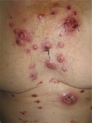 Figure 4 Bullous variant of pyoderma gangrenosum, in a patient with acute myeloid leukemia, presenting overlap features with bullous variant of Sweet’s syndrome.