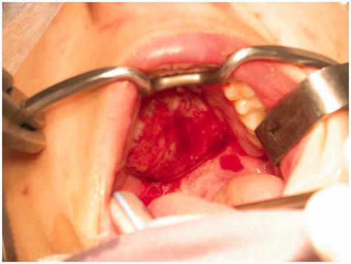 Figure 1. Exophytic nonulcerative mass of the hard palate.