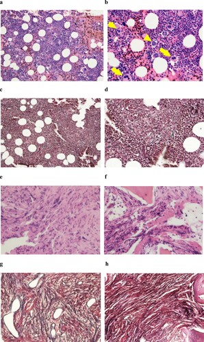 Figure 1. Bone marrow histology in low-power (a and c; x100) or high-power (b and d ∼ h; x400) fields at diagnosis (a ∼ d), transformation into fibrosis (e and g) and the exaggerated thrombocytosis phase (f and h). a, b: H-E staining revealed slightly hyperplastic bone marrow with an increased number of dysplastic megakaryocytes. Two distinct types of dysplastic megakaryocytes were observed. One type exhibited abundant and mature cytoplasm and deeply and hyperlobulated nuclei (staghorn-like), whereas the other type exhibited an altered nuclear:cytoplasmic ratio with abnormal chromatin clumping and plump (cloud-like) or bulbous (balloon-shaped) lobulation of the nuclei. These two types of abnormal megakaryocytes formed loose clusters. Arrows and arrowheads indicate abnormal megakaryocytes with staghorn-like and cloud-like nuclei, respectively. c, d: Silver staining of the initial bone marrow biopsy revealed a very loose network of reticulin fibre, and the condition was categorized as grade 0 myelofibrosis (MF-0) based on the criteria of the European consensus on grading bone marrow fibrosis. e, f: H-E staining revealed infiltration of dysplastic megakaryocytes in the secondary (e) and tertiary (f) analyses. g, h: Silver staining of the secondary (g) and tertiary (h) bone marrow biopsy revealed obvious fibrosis. Compared with the secondary biopsy (g), the tertiary sample (h) exhibited more prominent fibrosis.
