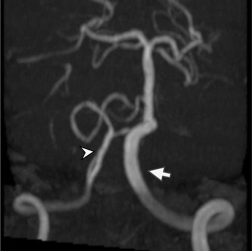 Figure 5 3D TOF MRA of the posterior circulation reveals dolichoectatic left vertebral artery with redundancy to the right (arrow).