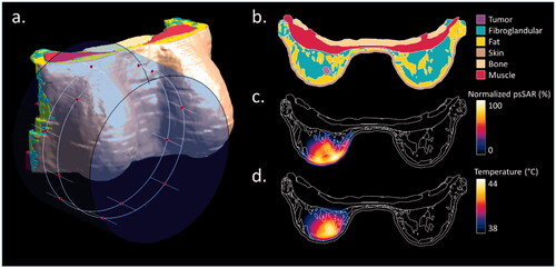 Figure 4. Treatment planning setup and results in a single patient (Patient 10). (a) The water bolus and dipole antennas positions (red dots) distributed along two rings around the breast tissue; (b) tissue discretization in an axial slice passing through the center of the tumor; (c) normalized 1 g averaged SAR distribution on the same slice after THQ optimization; (d) steady-state temperature distribution on the same slice.