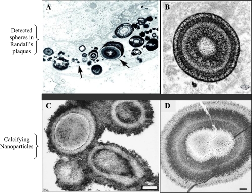 Figure 1 Morphological similarities of published TEM images of spherical, apatite-containing formations in renal papillae (A and B) and CNP (C and D). Magnifications: A, 20,000X; B, 30,000X; C and D, bars 200 nm. Reprinted from A: Coe FL, Evan A, Worcester E. 2005. Kidney stone disease. J Clin Invest, 115:2598–2608, with permission from American Urological Association. B: Matlaga BR, Coe FL, Evan AP, et al 2007. The role of Randall’s plaques in the pathogenesis of calcium stones. J Urol, 177:31–38, with permission from American Urological Association. C: Kajander EO, Ciftcioglu N. 1998. Nanobacteria: an alternative mechanism for pathogenic intra- and extracellular calcification and stone formation. Proc Natl Acad Sci USA, 95:8274–8279, with permission from National Academy of Sciences USA. D: Kajander EO, Ciftcioglu N, Aho K, et al 2003. Characteristics of nanobacteria and their possible role in stone formation. Urol Res, 31:47–54, with kind permission from Springer Science and Business Media.